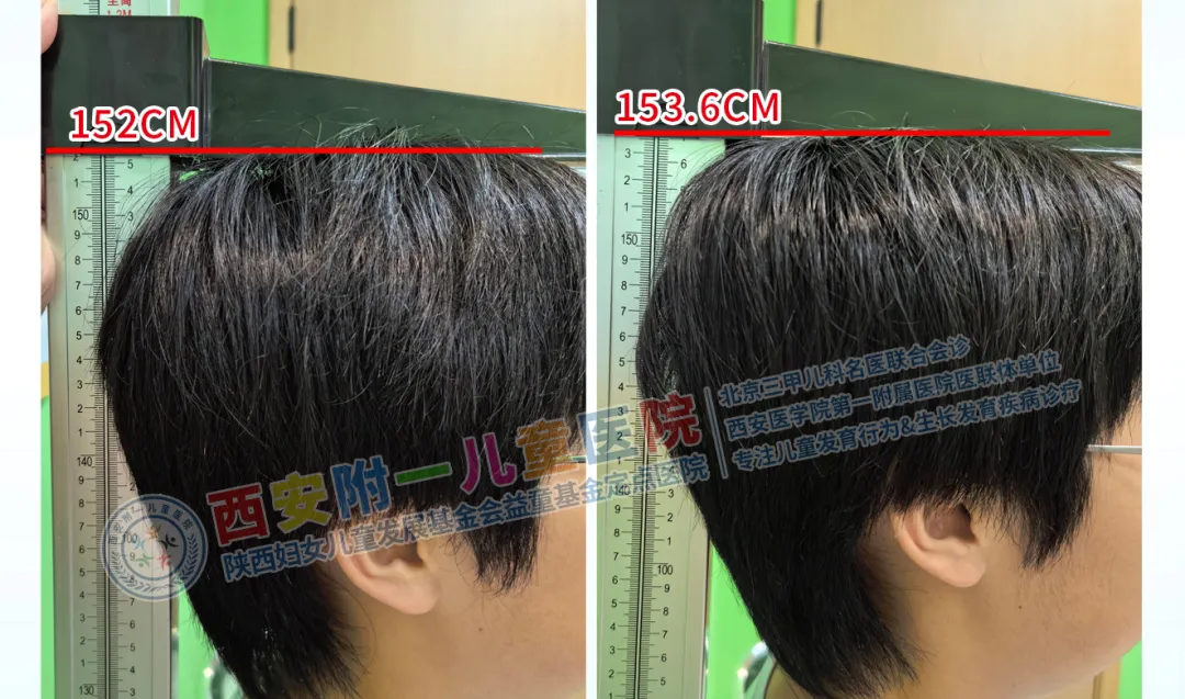 舞蹈少女的“增高”奇迹：别让“晚长”观念耽误了孩子的职业梦想